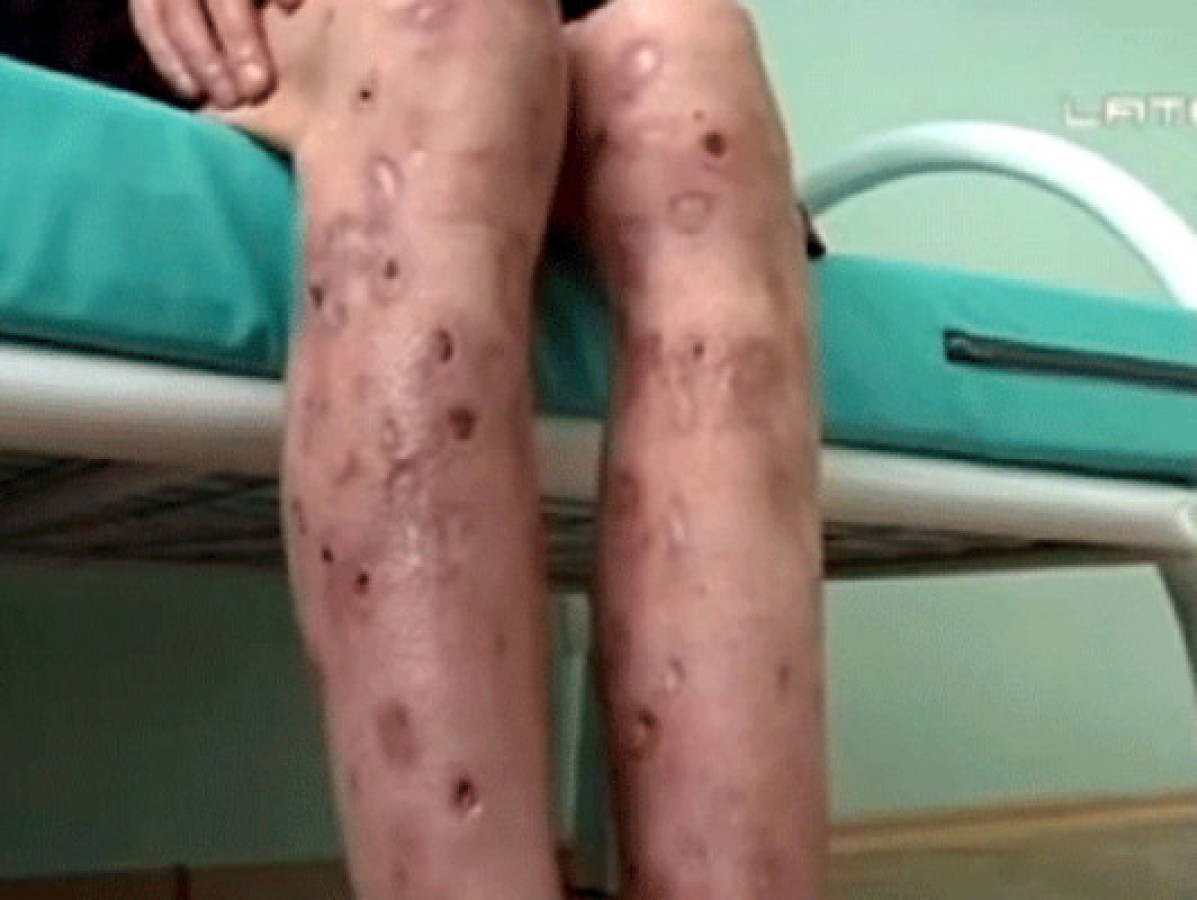 Krokodil', la droga que devora la piel y tiene en alerta al mundo