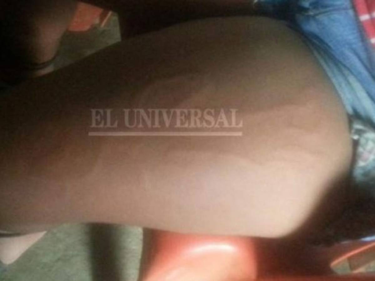 ¿Brujería? Extraña figura de una 'muñeca que baila” aparece en la pierna de una niña en Colombia