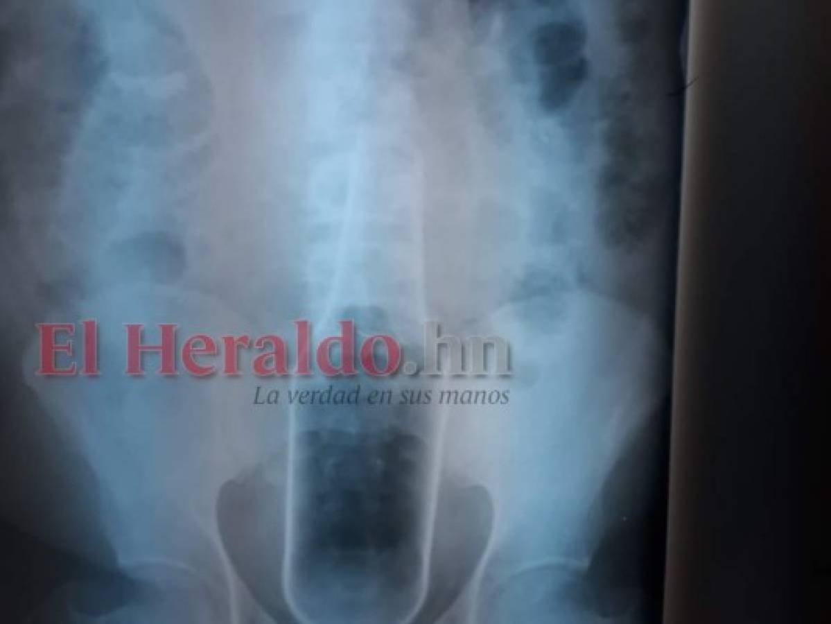 Honduras: Operan a hombre que se introdujo una botella en el ano