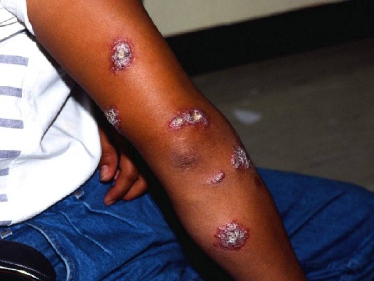 Salud refuerza vigilancia por leishmaniasis en Honduras