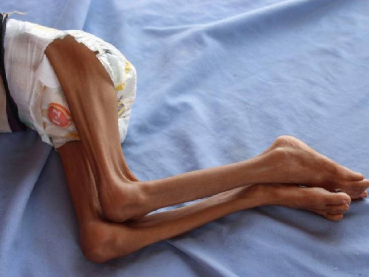 La terrible hambruna que amenaza a más de cinco millones de niños en Yemen