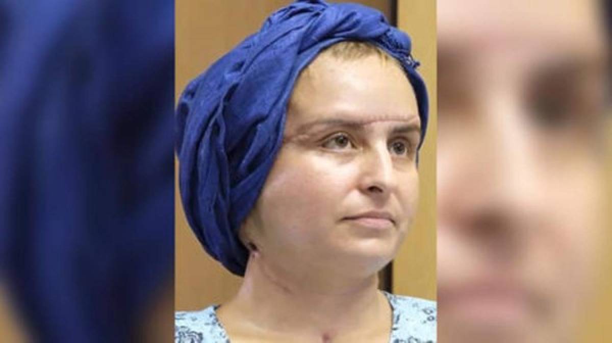 El radical cambio de una mujer que se sometió a una cirugía de cambio de rostro