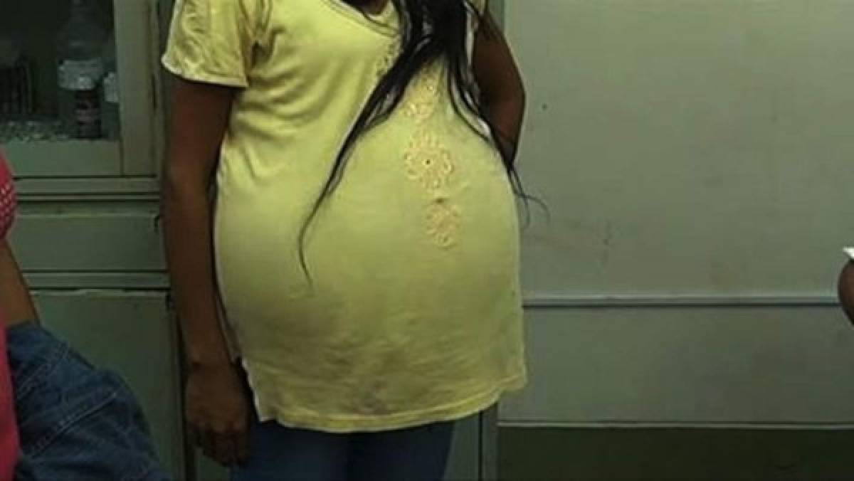 Médicos le extraen un tumor de 16 kilos a una mujer peruana