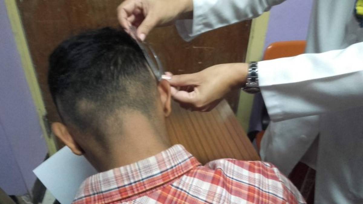 Honduras: Aplican tratamientos gratis para la caída del pelo en el Hospital Escuela Universitario