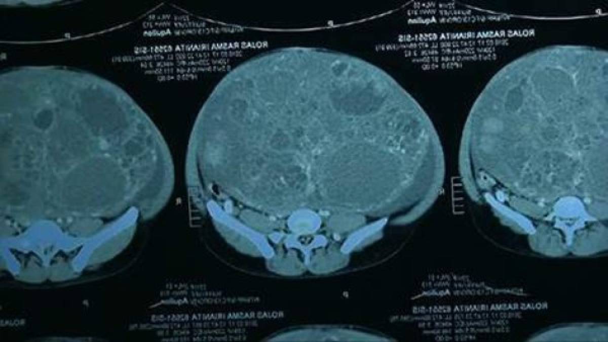 Médicos le extraen un tumor de 16 kilos a una mujer peruana