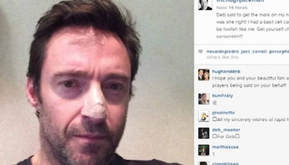 El actor australiano Hugh Jackman con cáncer de piel