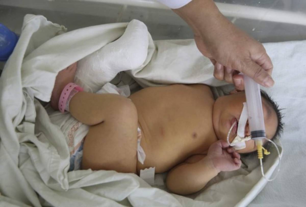 Nacen 10 niños más con microcefalia y casos suben a 74