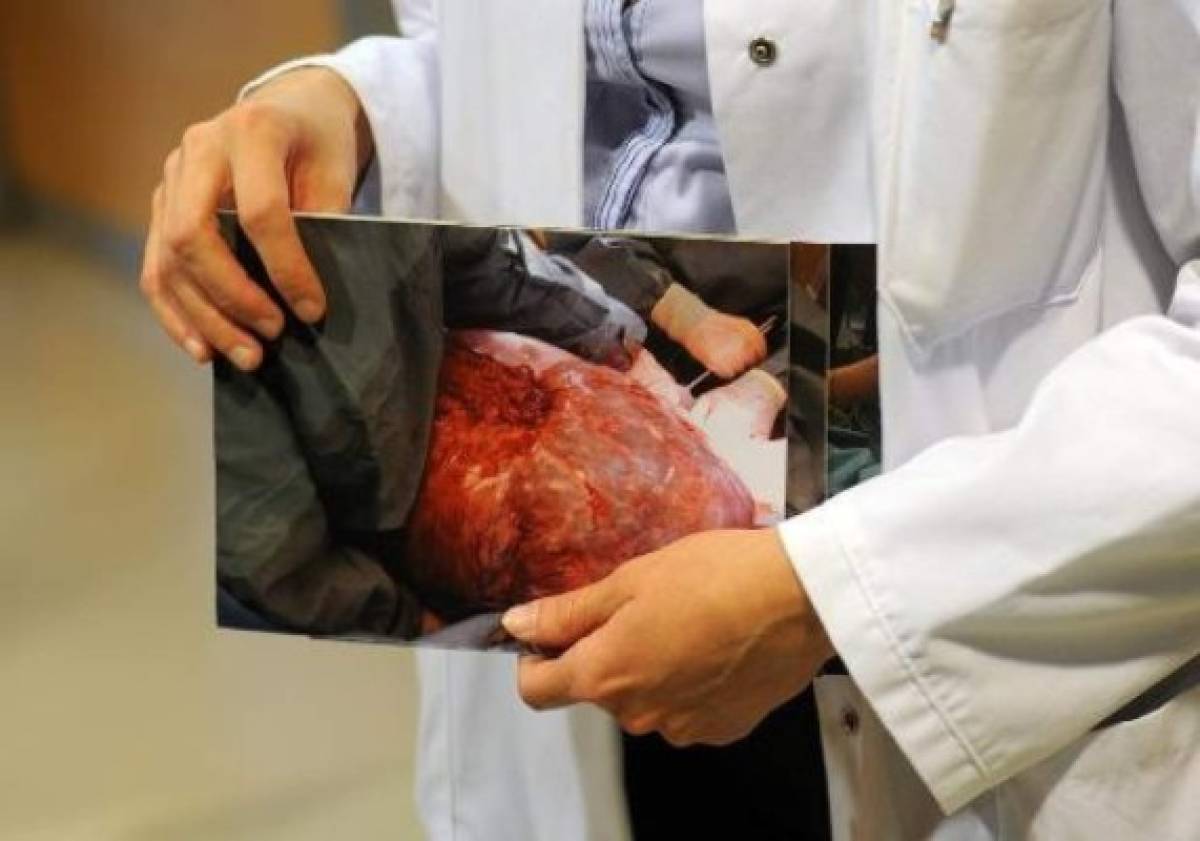 Médicos le extraen un tumor de 16 kilos a una mujer peruana