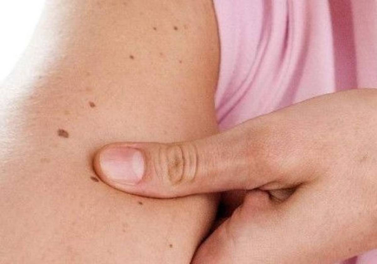 Tener más de 11 lunares en el brazo derecho indica riesgo de melanoma    