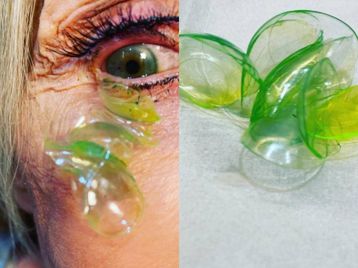 Remueven 23 lentes de contacto del ojo de una anciana en California