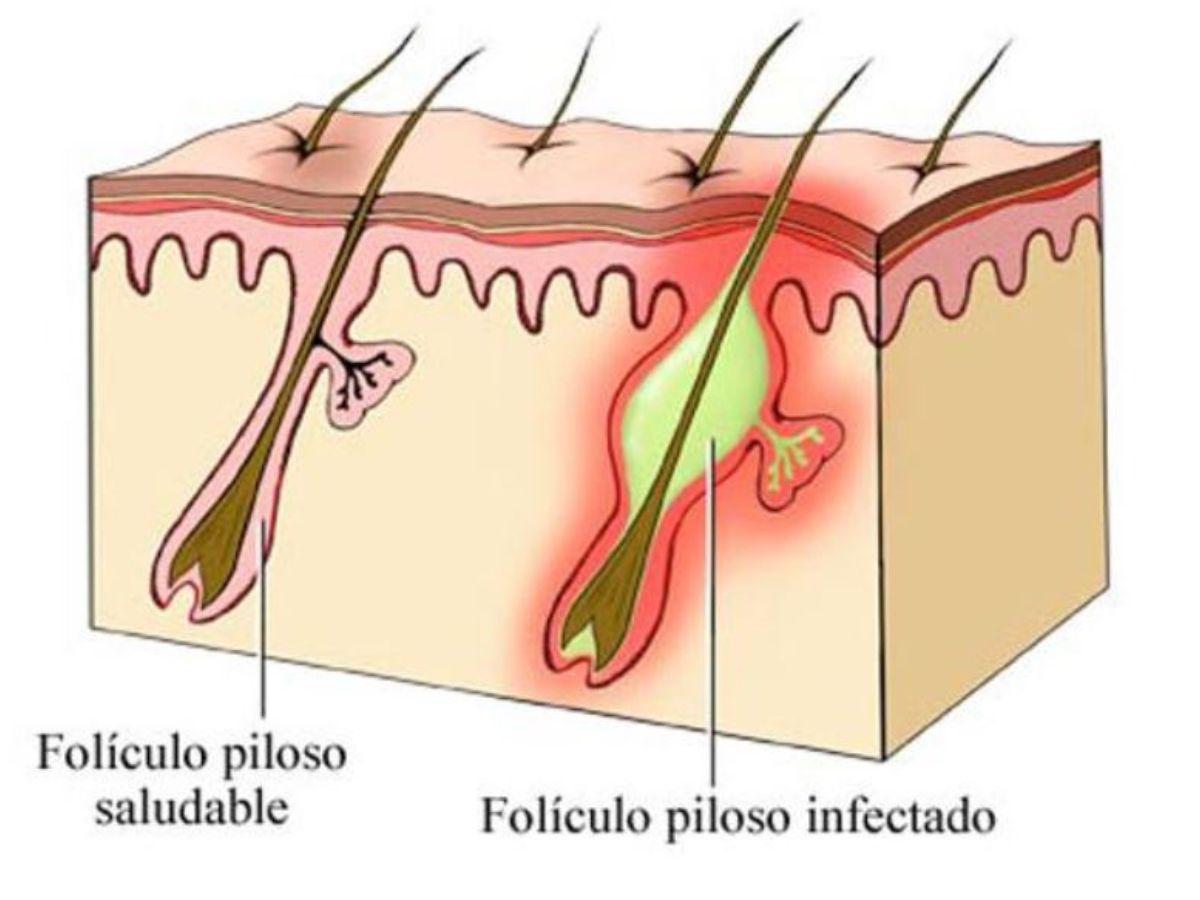 Vista de un folículo saludable y uno infectado, llegando a producir erupciones que por un mal tratamiento devienen en lesiones similares a las de la viruela del mono.