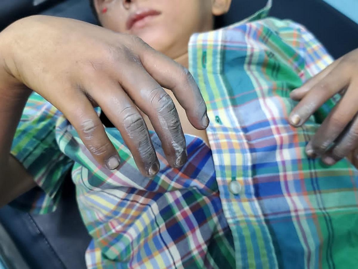 Niño sufre quemaduras por pólvora en Marcovia, Choluteca