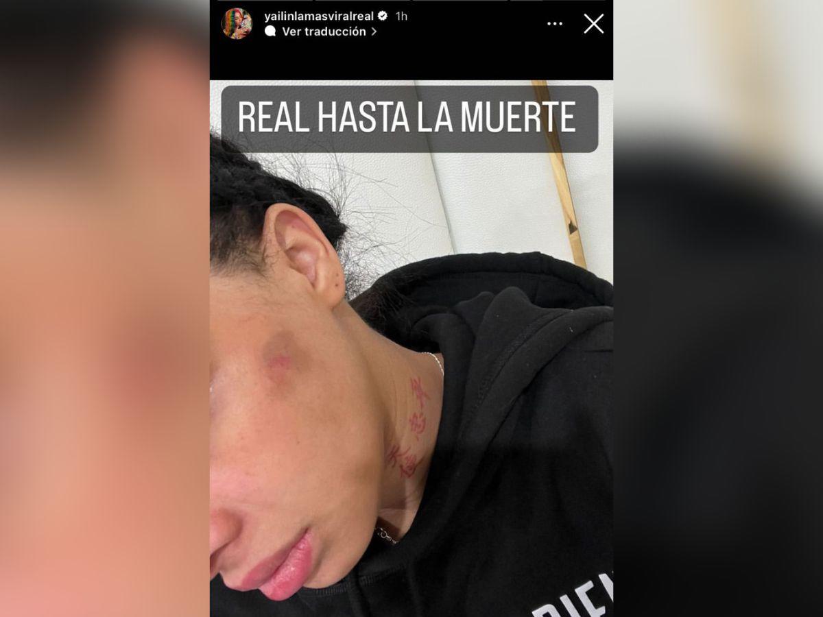 En la imagen la cantante muestra los golpes que recibió presuntamente por parte de Anuel.