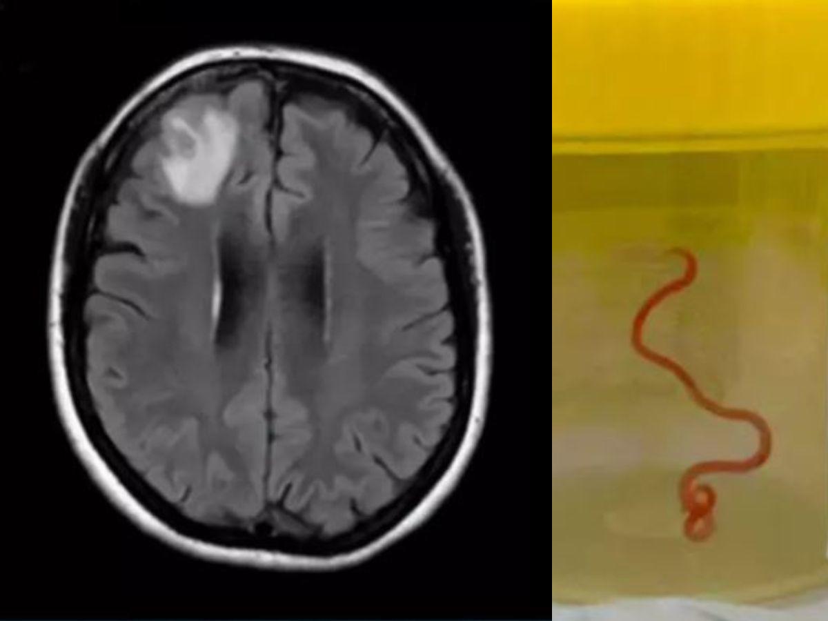 Mujer australiana tenía un enorme gusano vivo en el cerebro