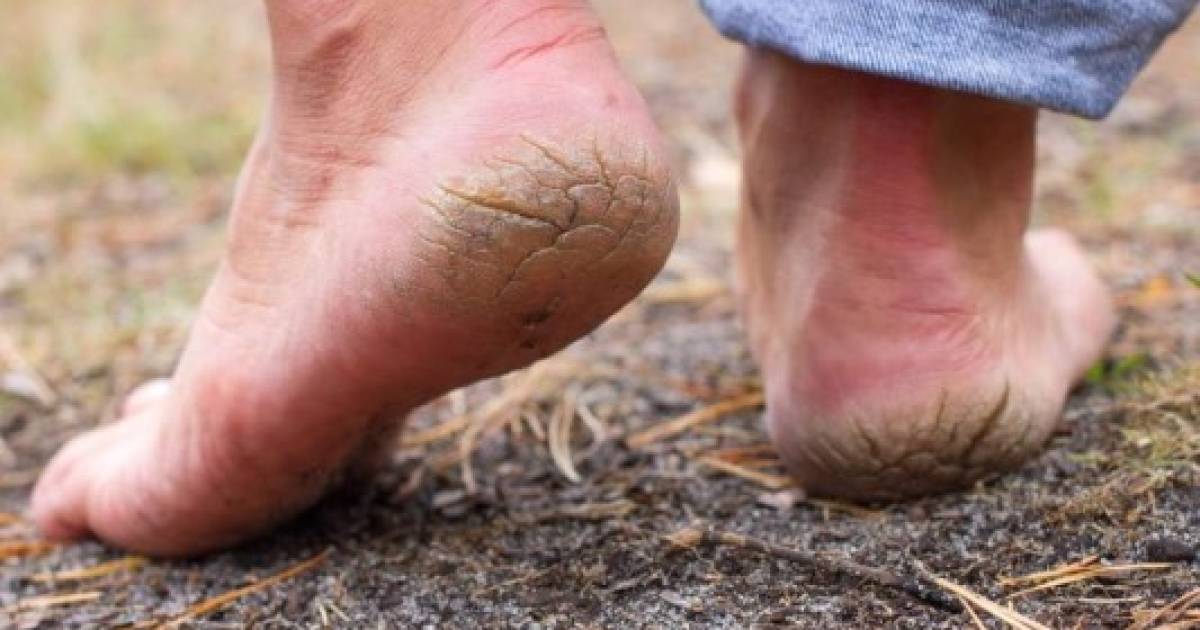 ¿Talones agrietados? Hidrátalos con estos tres efectivos remedios caseros