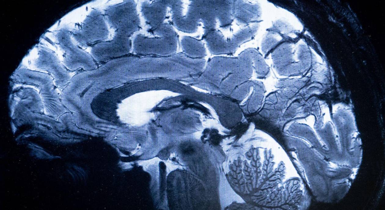 Estudios revelan que personas con daño cerebral muestran cierta percepción