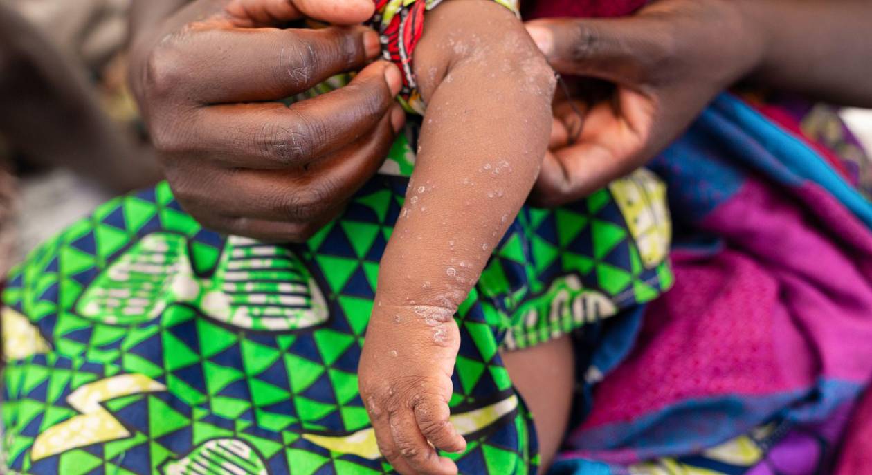 Mpox, una crisis sanitaria que amenaza propagarse más allá de fronteras del Congo