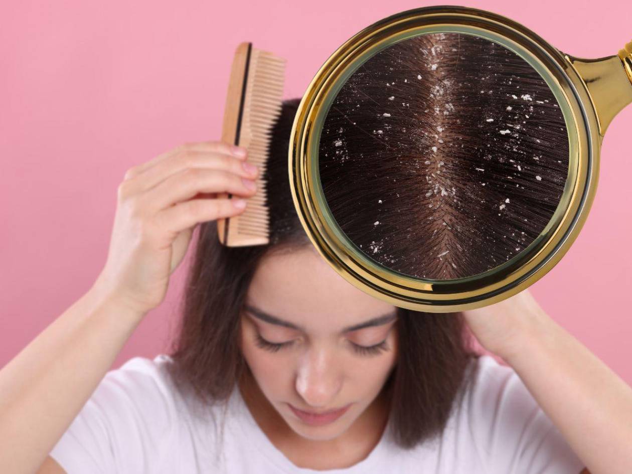 Salud capilar: un experto explica cómo eliminar la caspa del cabello