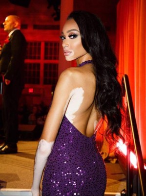 FOTOS: Winnie Harlow, la modelo que sería la nueva novia de Maluma