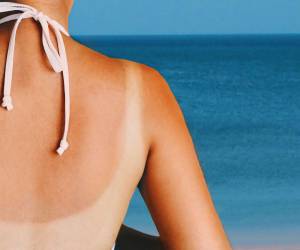 El tratamiento de las quemaduras por el sol no cura la piel, pero puede aliviar el dolor, la hinchazón y las molestias.