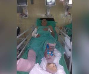 Don Eduardo, de 75 años, sufrió fracturas en la mano y brazo derecho, fractura de tibia y peroné en la pierna izquierda, así como lesiones en ambas rodillas que requieren de cirugía y otra lesión en la mano que también necesita operación.