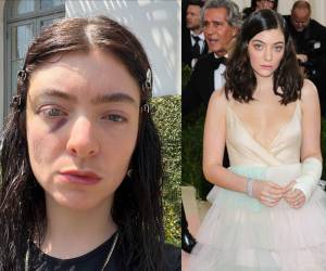 Lorde, de 27 años, generó preocupación y especulaciones el lunes al compartir una serie de fotos en su cuenta de Instagram, en las que revelaba un ojo morado.