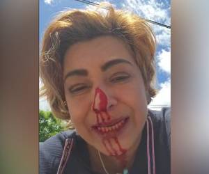 Marlene Alvarenga sufrió golpiza en la colonia Hato de Enmedio; joven en moto la perseguía