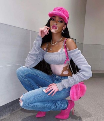 FOTOS: Winnie Harlow, la modelo que sería la nueva novia de Maluma