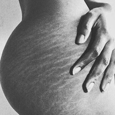 Famosas que mostraron sus estrías, celulitis y cicatrices en Instagram