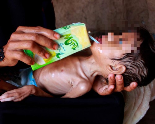 Impactantes y dolorosas imágenes de la desnutrición en Yemen