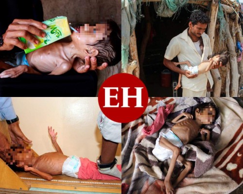 Impactantes y dolorosas imágenes de la desnutrición en Yemen