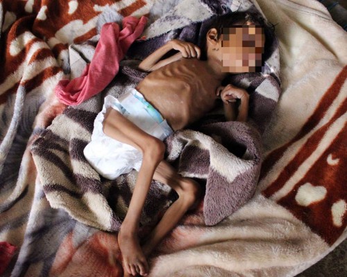 Impactantes y dolorosas imágenes de la desnutrición en Yemen