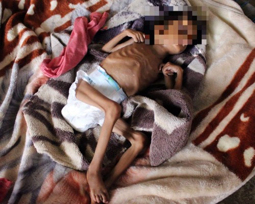 Impactantes y dolorosas imágenes de la desnutrición en Yemen