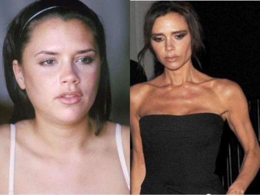 FOTOS: Famosas que sufrieron anorexia y otros problemas alimenticios