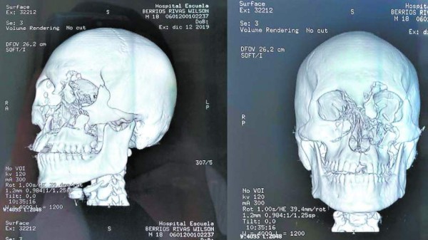 La evolución de Wilson Berríos tras fatal explosión en su rostro