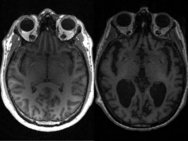 El Alzheimer provoca la pérdida de memoria y una creciente incapacidad para realizar las tareas cotidianas.