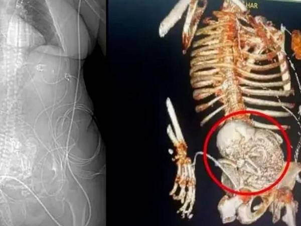 Litopedia, que significa bebé de piedra, es una afección causada porque el bebé no se desarrolla normalmente y termina siendo un feto calcificado.