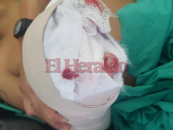 La víctima, residente en el barrio Guanacaste de Tegucigalpa, él lanzó una 'cebolla' y como vio que no explotó, regresó, la tomó, y al levantarla le estalló en la mano.