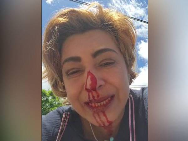 Marlene Alvarenga sufrió golpiza en la colonia Hato de Enmedio; joven en moto la perseguía