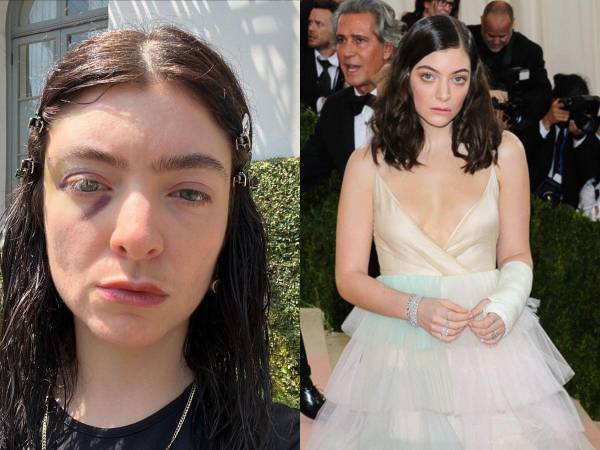 Lorde, de 27 años, generó preocupación y especulaciones el lunes al compartir una serie de fotos en su cuenta de Instagram, en las que revelaba un ojo morado.