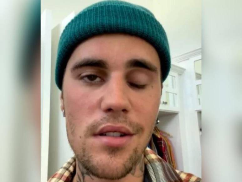 ¿Qué es el síndrome de Ramsay Hunt, causante de la parálisis facial de Justin Bieber?