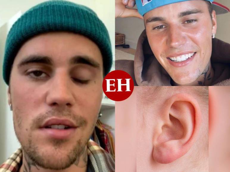 ¿Qué es el síndrome de Ramsay Hunt, causante de la parálisis facial de Justin Bieber?