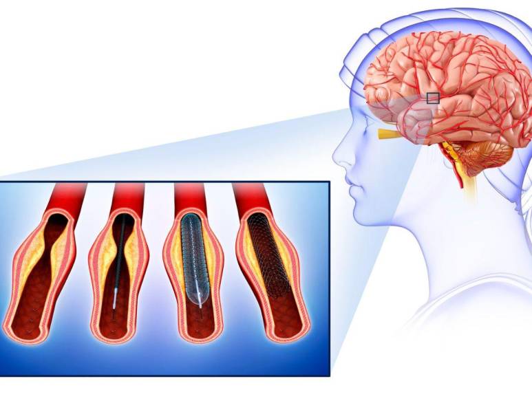 Enfermedad cerebrovascular, la afección que mantiene en Cuidados Intensivos a Oswaldo Ramos Soto