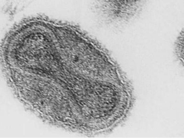 Lo que se sabe de la viruela del mono, enfermedad que alarma a Europa