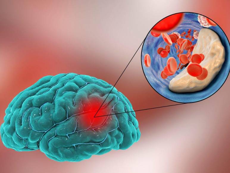 Enfermedad cerebrovascular, la afección que mantiene en Cuidados Intensivos a Oswaldo Ramos Soto