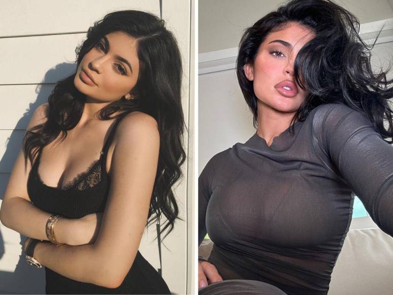 Kylie Jenner confiesa cirugía estética a los 19 años: ¿Se arrepiente?