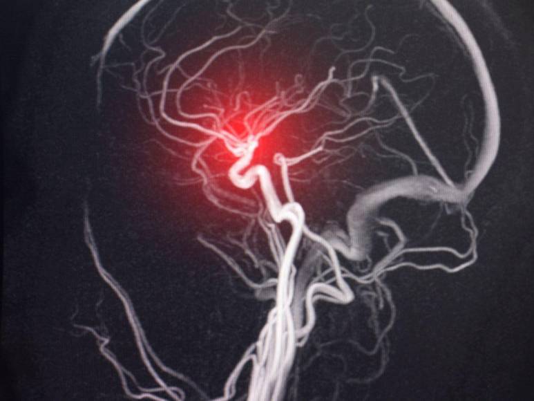 Enfermedad cerebrovascular, la afección que mantiene en Cuidados Intensivos a Oswaldo Ramos Soto