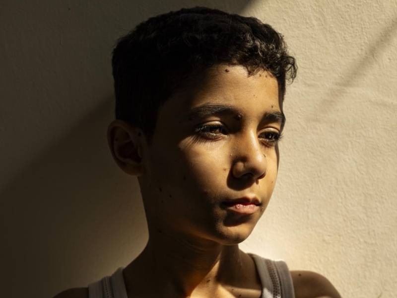 Una explosión arrancó una de las manos de Mahmoud Ajjour y destrozó la otra. Mahmoud, de 9 años, usa sus pies para todo. Dijo que quiere prótesis.