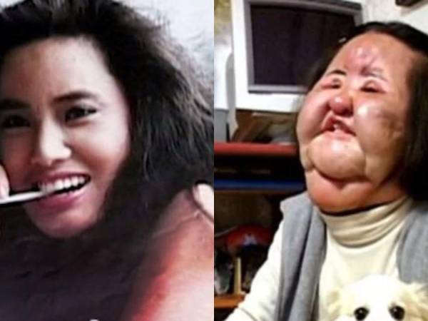 Su obsesión por ser más bella le arruinó la vida completamente. Conozca el caso de Hang Miok, la exmodelo de Corea del Sur que decidió inyectarse aceite de cocina en la cara luego de que los médicos se negaran a seguir con el tratamiento de bótox.