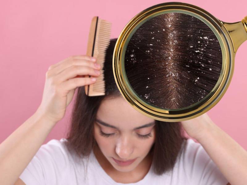 Salud capilar: un experto explica cómo eliminar la caspa del cabello